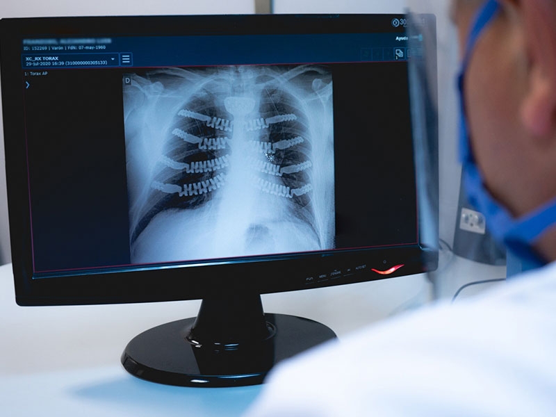 Innovadora reconstrucción torácica con prótesis 3D a medida - Hospital Privado Cordoba
