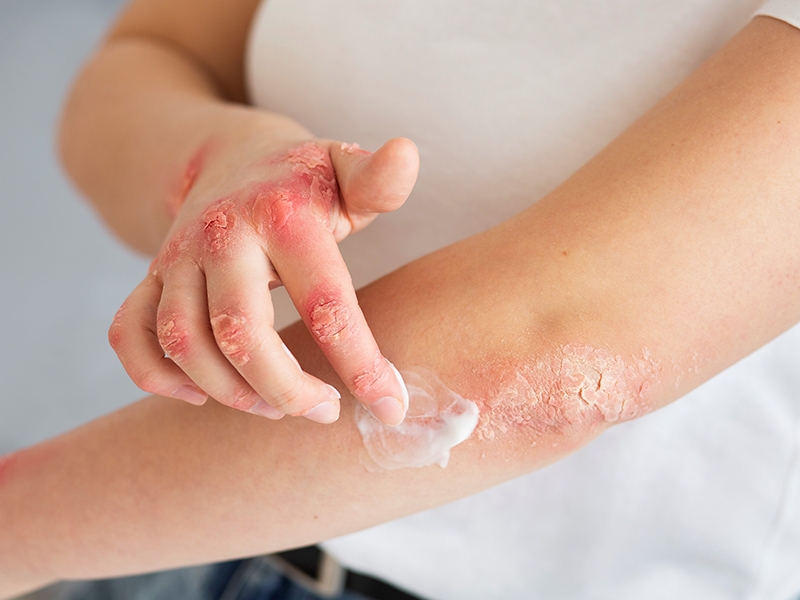 Enfermedad psoriásica: el abordaje en nuestro Hospital - Hospital Privado Cordoba